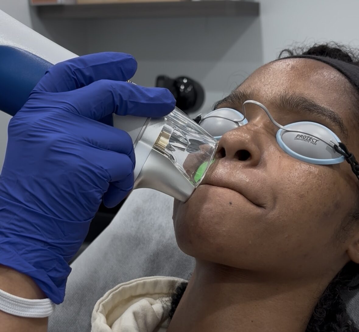 laser hair removal bronx