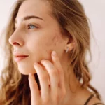 chemical peel in the bronx, ny
